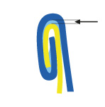 Đo chiều cao khe hở mí